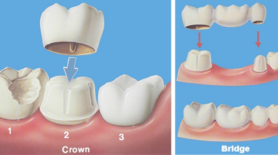 Fogkorona - fog pótlás